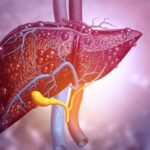 3-year Study Outcomes Demonstrate ‘Durable’ Response to Seladelpar for PBC